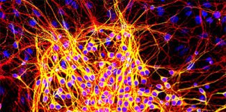 Protein Mutations Associated with Alzheimer’s Linked to Cancer Risk