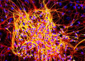 Protein Mutations Associated with Alzheimer’s Linked to Cancer Risk Protein Mutations Associated with Alzheimer’s Linked to Cancer Risk