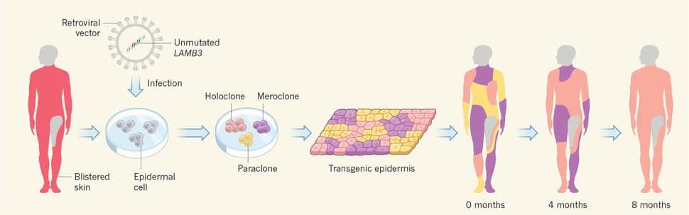Scientists Give Boy Suffering From JEB Entirely New Skin - Gene Therapy
