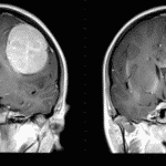 “Electric Cap” Shown to Prolong Survival in Deadly Brain Cancer