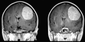 “Electric Cap” Shown to Prolong Survival in Deadly Brain Cancer