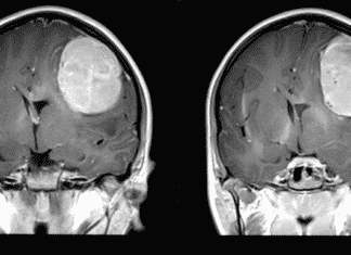 “Electric Cap” Shown to Prolong Survival in Deadly Brain Cancer “Electric Cap” Shown to Prolong Survival in Deadly Brain Cancer