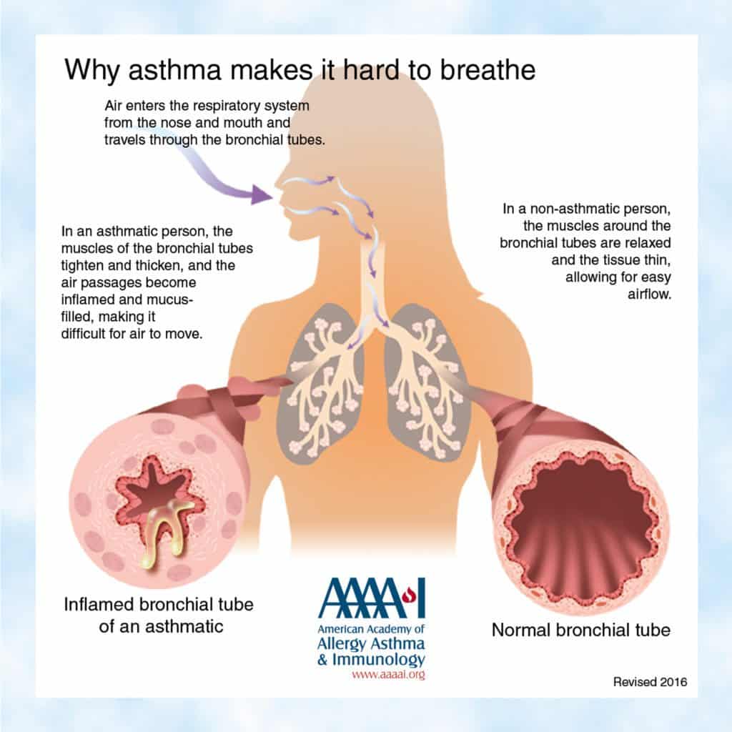 Five New Loci Associated with Asthma Found : Study