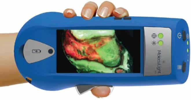 Handheld Wound Intelligence Device Helps Visualise Bacteria at Area of Infection