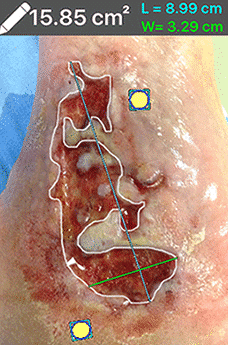 Handheld Wound Intelligence Device Helps Visualise Bacteria at Area of Infection