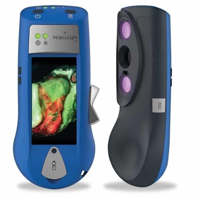 Handheld Wound Intelligence Device Helps Visualise Bacteria at Area of Infection