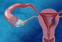 Intending to Target Endometrial Cancer Researchers Design Nanoparticles Loaded with Drugs Endometrial Cancer Researchers Design Nanoparticles Loaded with Drugs