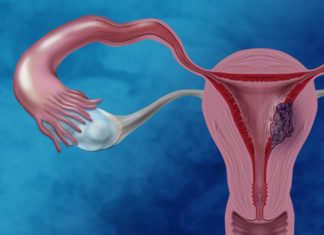 Intending to Target Endometrial Cancer Researchers Design Nanoparticles Loaded with Drugs Endometrial Cancer Researchers Design Nanoparticles Loaded with Drugs