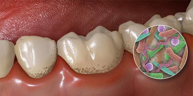 Study Links Bad Oral Health to Risks of Oesophageal Cancer