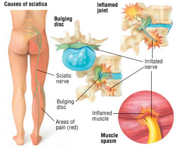A 10-Minute, Pulsed Radio Therapy to Assuage Your Lower Back Pain