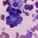 Boosting Oestrogen Activity Gives Hope of New Neuroblastoma Treatment Possibilities Boosting Oestrogen Activity For New Neuroblastoma Treatment Possibility