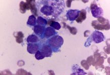 Boosting Oestrogen Activity Gives Hope of New Neuroblastoma Treatment Possibilities Boosting Oestrogen Activity For New Neuroblastoma Treatment Possibility