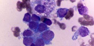 Boosting Oestrogen Activity For New Neuroblastoma Treatment Possibility