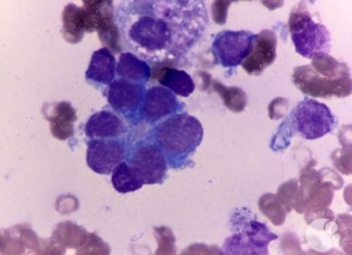Boosting Oestrogen Activity Gives Hope of New Neuroblastoma Treatment Possibilities Boosting Oestrogen Activity For New Neuroblastoma Treatment Possibility