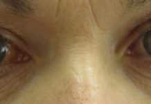 NanoLens : Dissolving Contact Lenses with Therapeutic Benefit for Glaucoma Patients Dissolving Contact Lenses with Therapeutic Benefit for Glaucoma Patients