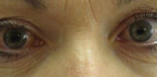 Dissolving Contact Lenses with Therapeutic Benefit for Glaucoma Patients