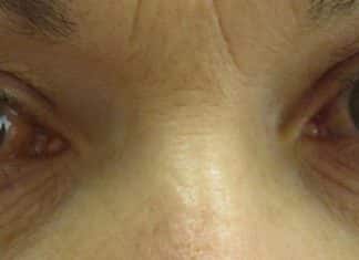 Dissolving Contact Lenses with Therapeutic Benefit for Glaucoma Patients