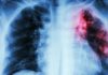 BCG to Rouse Innate Immune System through Bone Marrow Stem Cells