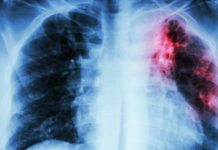 BCG Could Rouse Innate Immune System through Bone Marrow Stem Cells BCG to Rouse Innate Immune System through Bone Marrow Stem Cells