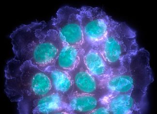 Spanish scientists have described a mechanism involved in bone metastatic latency of oestrogen receptor-positive (ER+) breast cancer