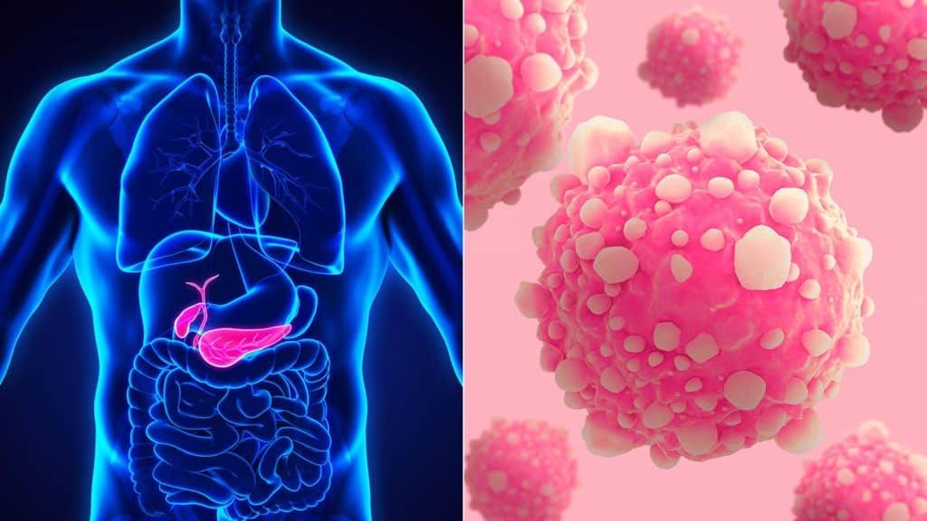 Researchers Reform Flu Virus to Inhibit Pancreatic Cancer