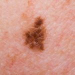 Rare Melanoma Type Highly Sensitive to Immunotherapy: Study