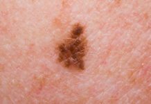 Rare Melanoma Type Highly Sensitive to Immunotherapy: Study Rare Melanoma Type Highly Sensitive to Immunotherapy: Study