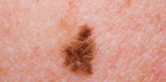 Rare Melanoma Type Highly Sensitive to Immunotherapy: Study