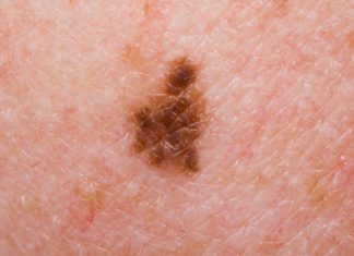 Rare Melanoma Type Highly Sensitive to Immunotherapy: Study