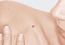 Soil Bacterium Could Be Potentially Effective Against Melanoma Soil Bacterium Could Be Potentially Effective Against Melanoma