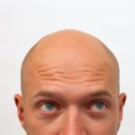 Indiana University School of Medicine researchers have cultured the first lab-grown skin tissue complete with hair follicles