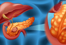 Researchers Reform Flu Virus to Inhibit Pancreatic Cancer Researchers Reform Flu Virus to Inhibit Pancreatic Cancer