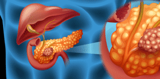 Researchers Reform Flu Virus to Inhibit Pancreatic Cancer