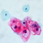 Tonsillar Crypts Might Shield HPV, Giving Way to Cancer