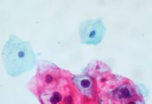 Tonsillar Crypts Might Shield HPV, Giving Way to Cancer Tonsillar Crypts Might Shield HPV, Giving Way to Cancer