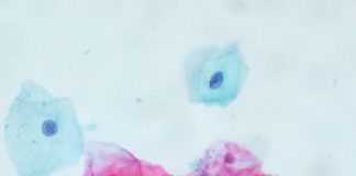 Tonsillar Crypts Might Shield HPV, Giving Way to Cancer