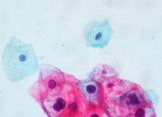 Tonsillar Crypts Might Shield HPV, Giving Way to Cancer Tonsillar Crypts Might Shield HPV, Giving Way to Cancer