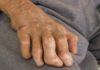 Genome-Wide Association Studies Reveal Rising Leprosy Resistance Trends Genome-Wide Association Studies Reveal Rising Leprosy Resistance