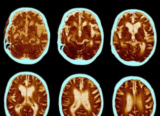 Enzyme Depletion Shown to Result in Alzheimer’s Reversal