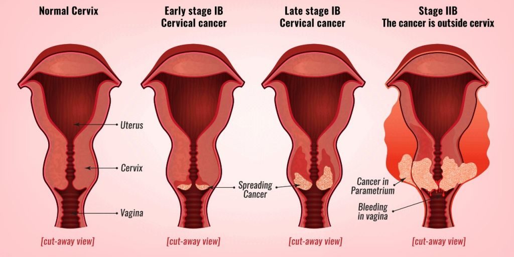 Australia Purging Cervical Cancer, Might be Able to Eradicate Disease Soon