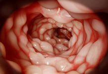 Alofisel, Crohn’s Stem Cell Therapy Approved by the EU