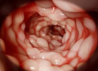 Alofisel, Crohn’s Stem Cell Therapy Approved by the EU