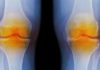 Biochemical Markers Indicative of Osteoarthritis Identified Using Nanotech