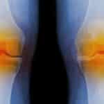 Biochemical Markers Indicative of Osteoarthritis Identified Using Nanotech