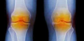 Biochemical Markers Indicative of Osteoarthritis Identified Using Nanotech