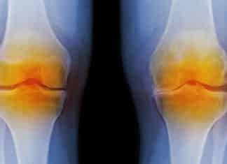 Biochemical Markers Indicative of Osteoarthritis Identified Using Nanotech Biochemical Markers Indicative of Osteoarthritis Identified Using Nanotech