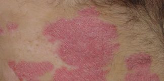 Macrophage-Derived Compound to Treat Autoimmune Disorders