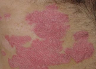 Macrophage-Derived Compound to Treat Autoimmune Disorders Macrophage-Derived Compound to Treat Autoimmune Disorders