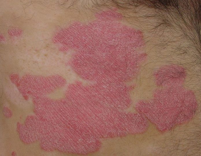 Macrophage-Derived Compound to Treat Autoimmune Disorders