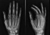 “Dripping Candle Wax” Bone Disease Genetic Cause Uncovered